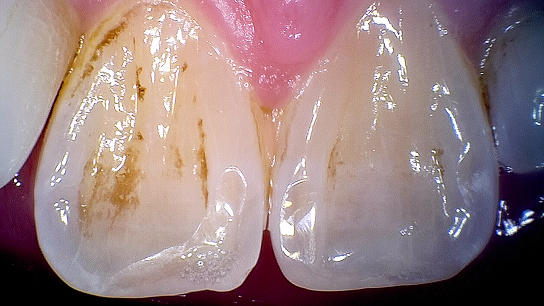 Smart Camera with Mouthwatch